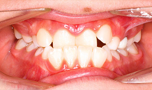 teeth anterior crossbite