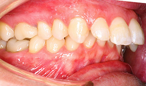 teeth overjet