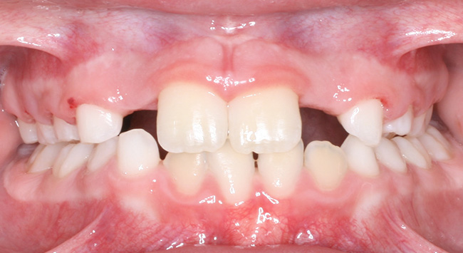 phase 1 diastema after