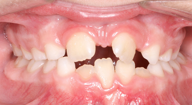 phase 1 diastema before