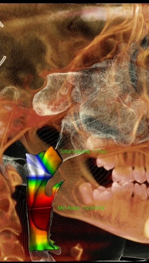 3d airway
