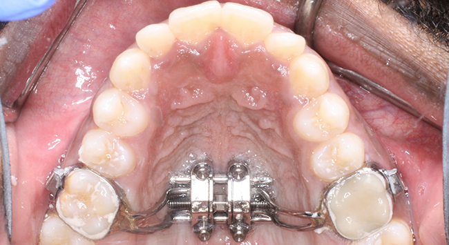mse occlusal after