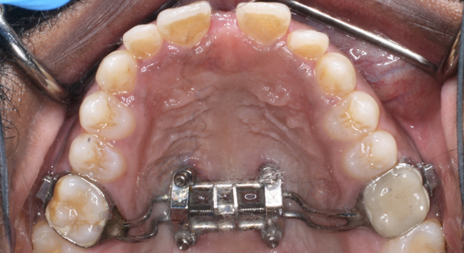 mse occlusal before