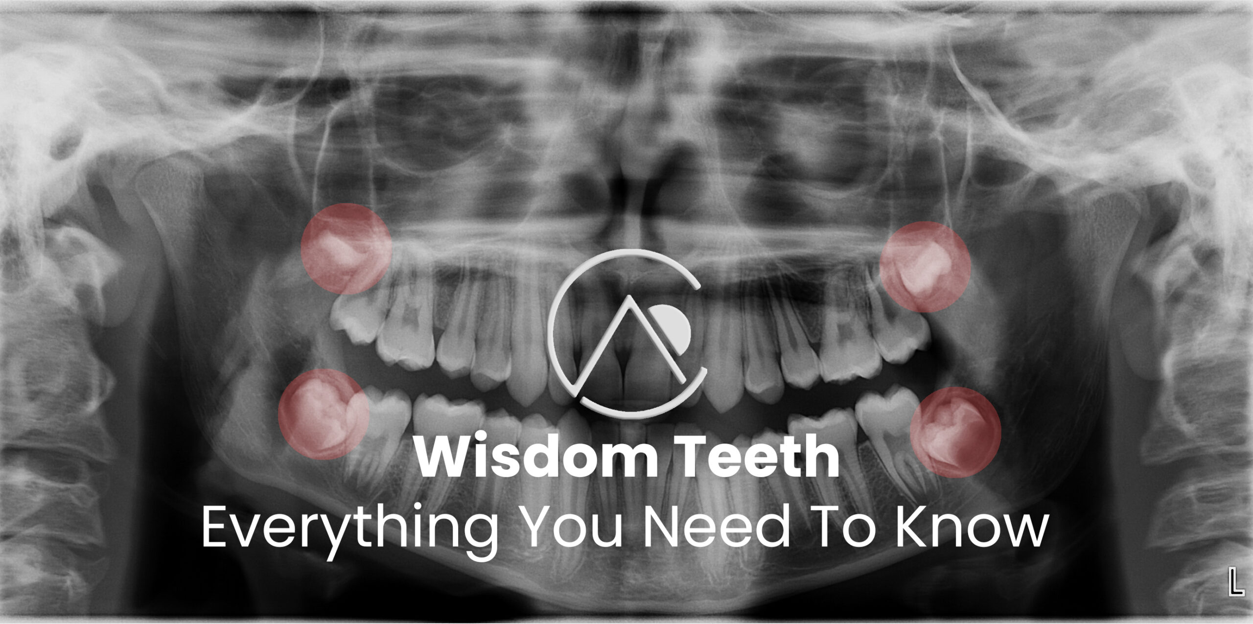 wisdom teeth scaled