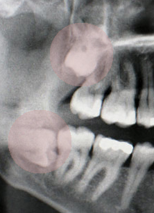 Wisdom Teeth: Everything You Need To Know