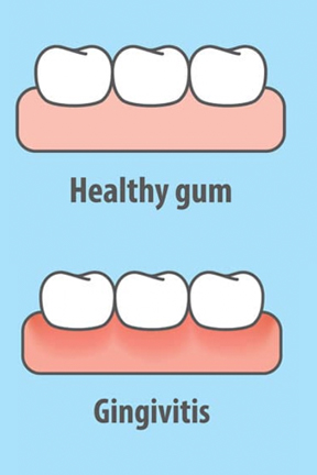 Preventing Gum Inflammation During Orthodontic Treatment