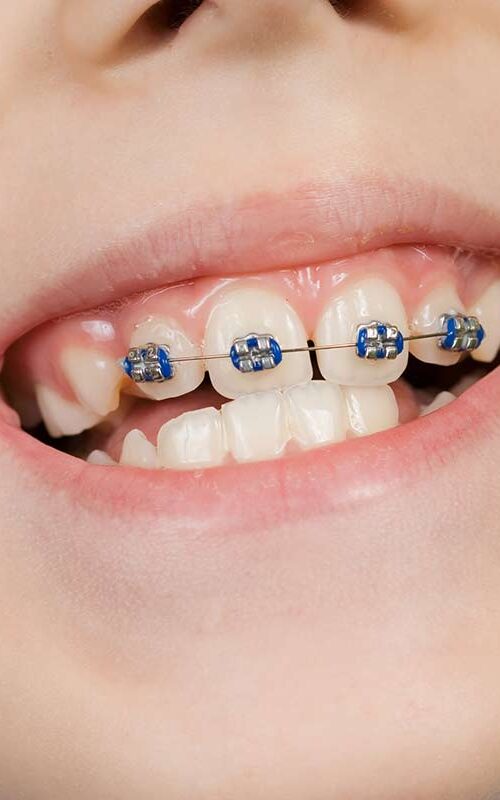 when should children start orthodontics