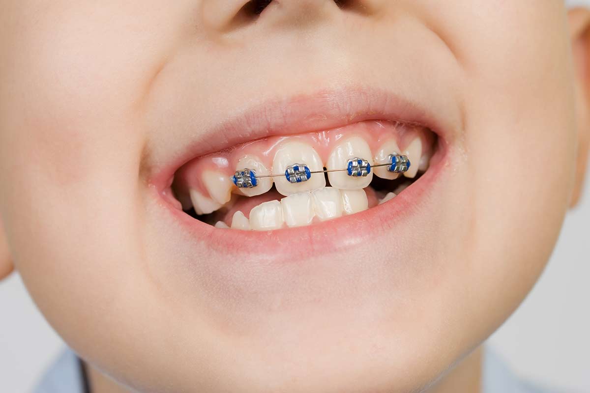 when should children start orthodontics