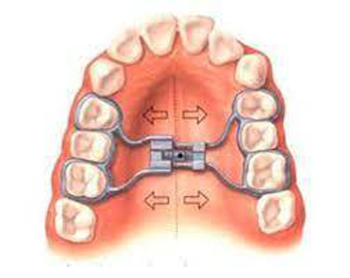 Breaking Boundaries: Can Adults Get Expanders?