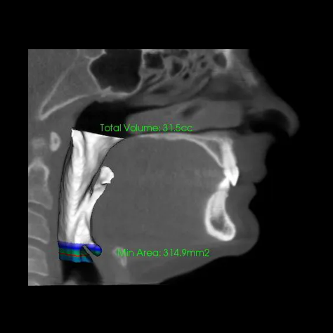 Airway-Focused Orthodontics: Why We’re Obsessed with the Airway